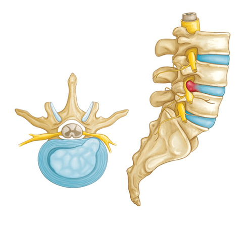 dor nas costas por hernia intervertebral