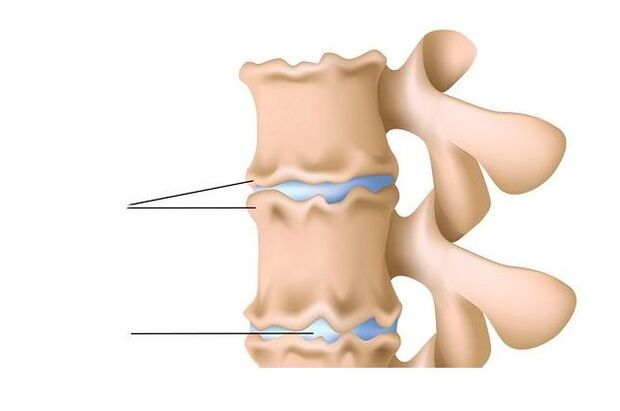 lesión da columna vertebral