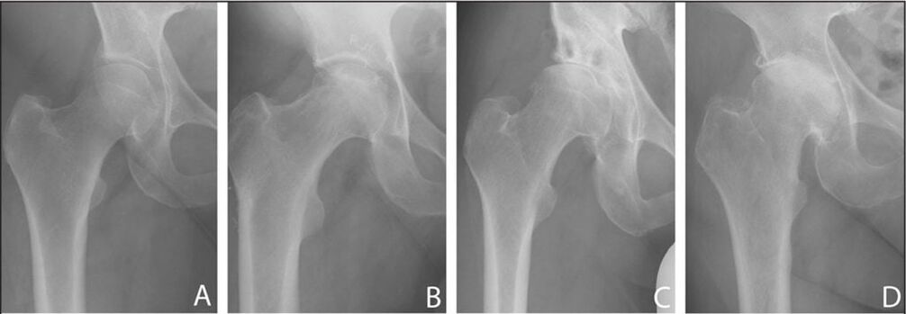 Fases do desenvolvemento da artrose da articulación da cadeira nunha radiografía