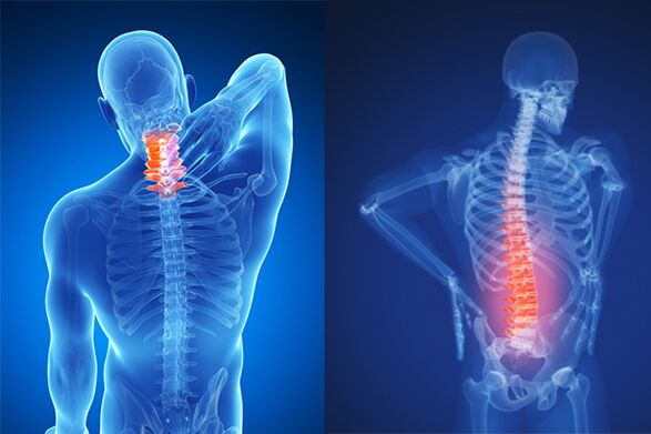Osteocondrose da columna cervical e lumbar