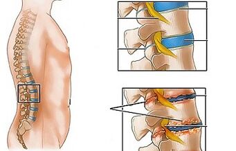As causas da osteocondrose do lumbar