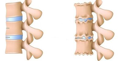 Como recoñecer a presenza de osteocondrose do lumbar