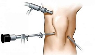 artroscopia para a artrose da articulación do xeonllo