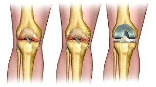 endopróteses para a artrose da articulación do xeonllo